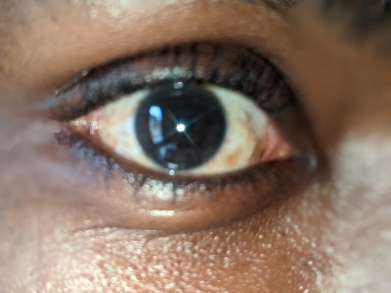 Conjonctivite Virale Surinfecté dit Apollo: Un nouveau problème de la santé public au sud Kivu